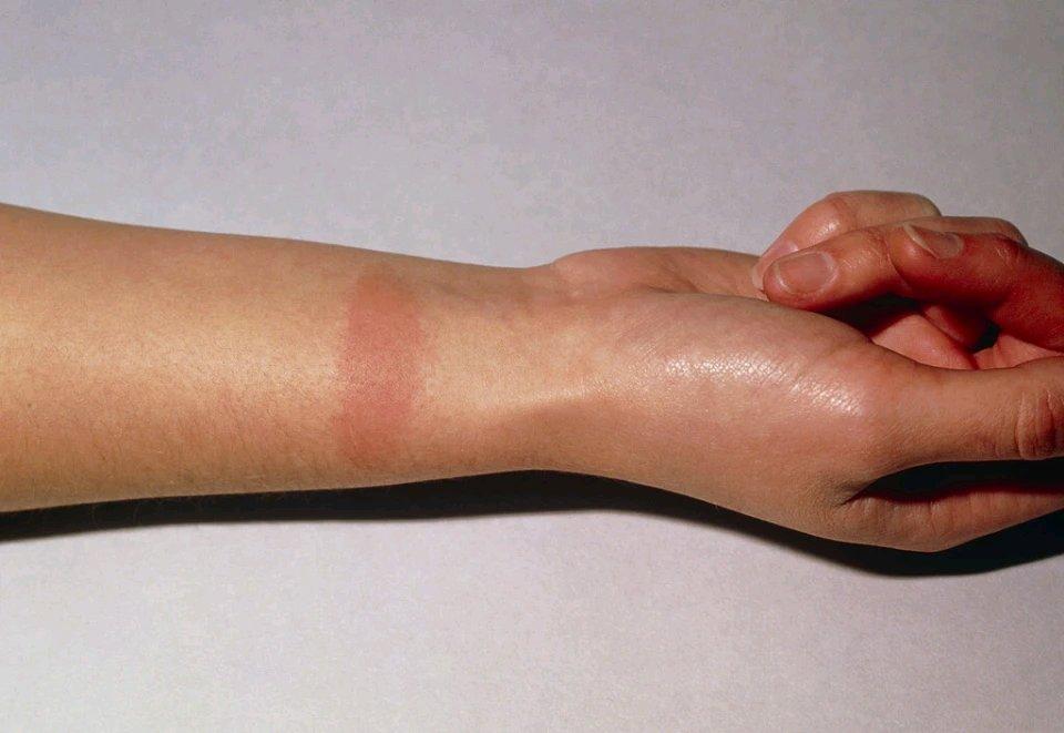 被热水烫到，很多人第一反应就是抹牙膏，我以前也这么干过。但其实这是个误区！被烫后