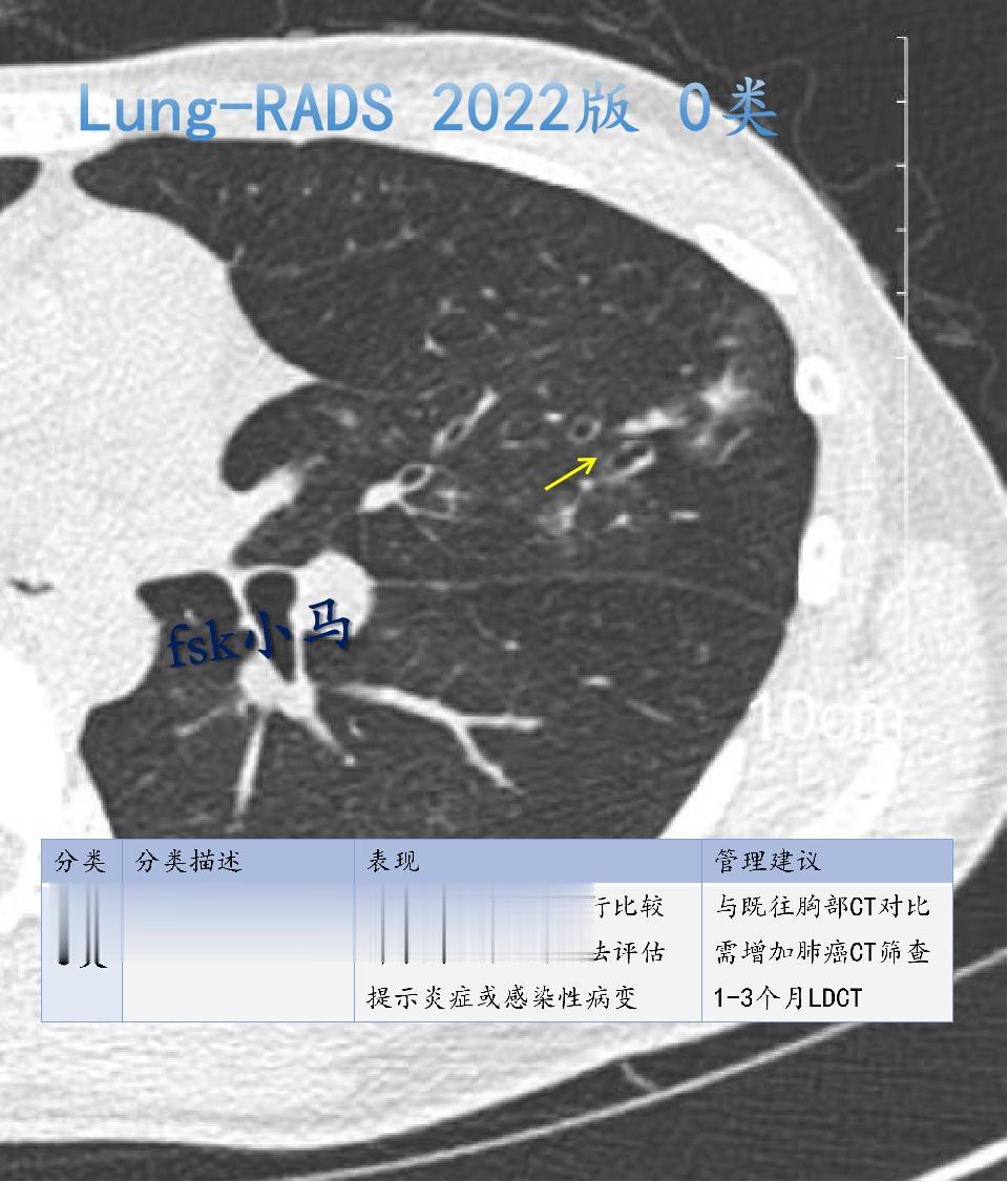 Lung-RADS 2022版 0类：不定类别，预期群体罹患率1%。表...