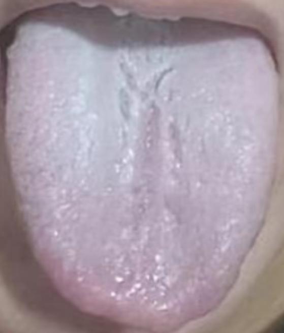 这种舌象，你就算是吃上一车补阳药，也远比不上一次通阳要来的实在！
 
我们先看看