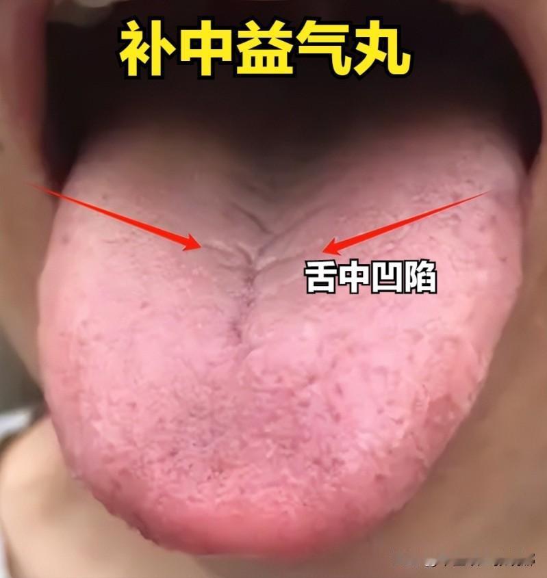 脾虚分两种： 舌中凹陷——补中益气芄； 舌中凸起——木香顺气芄

1、舌中凹陷