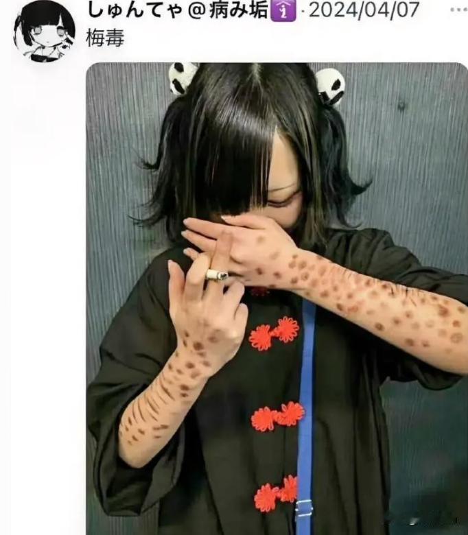 日本梅毒病例彻底爆发，诡异的是，年轻人不躲不藏，反而扎堆在网上公开“晒梅毒”，更