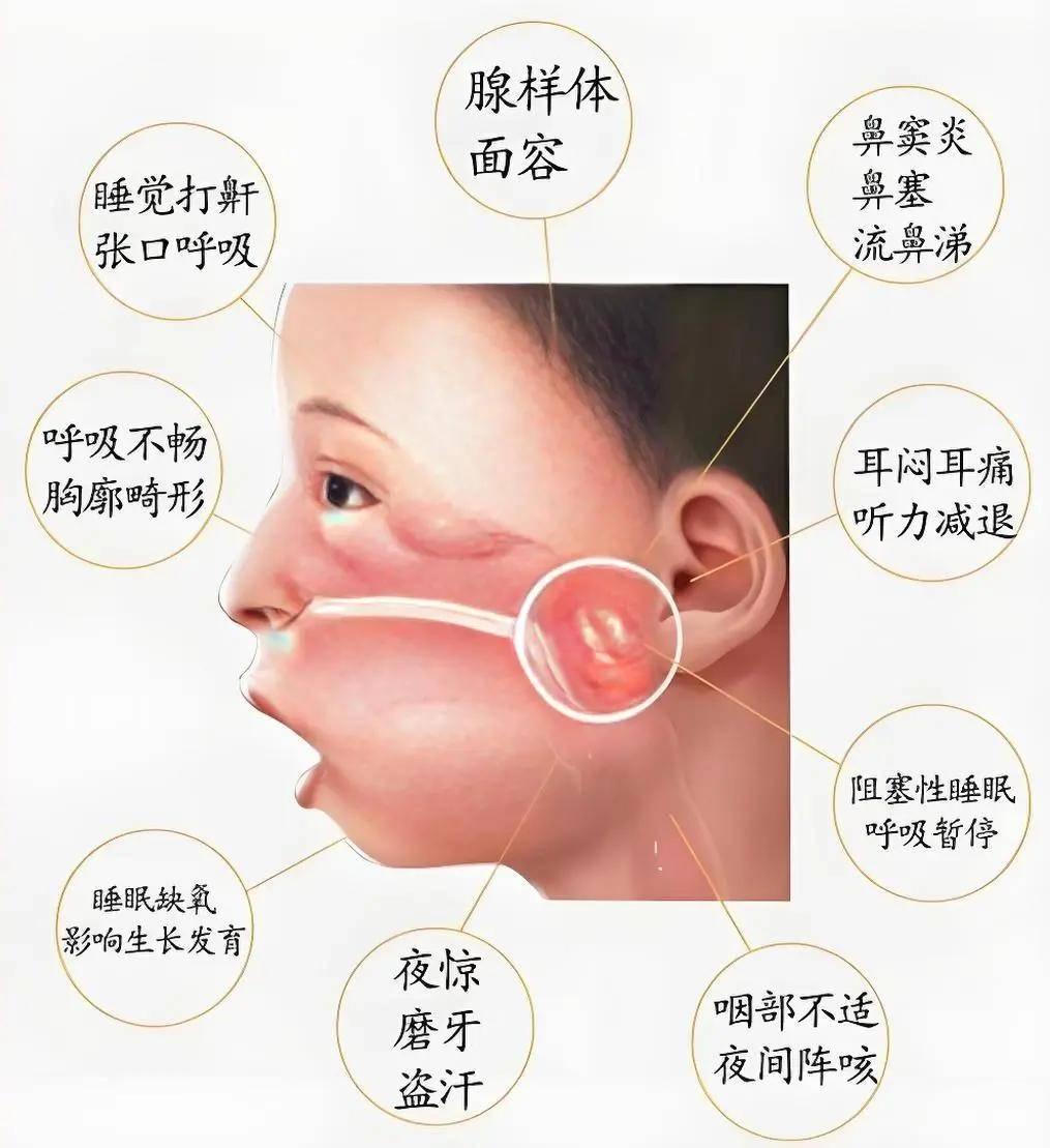 腺样体堵一半不用手术？孟主任：别干等，正是调理黄金期
每次门诊，总能遇见抱着报告