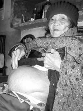 2007年，四川一位91岁高龄的老奶奶不慎摔倒，到医院检查后却发现她竟然还怀着孕