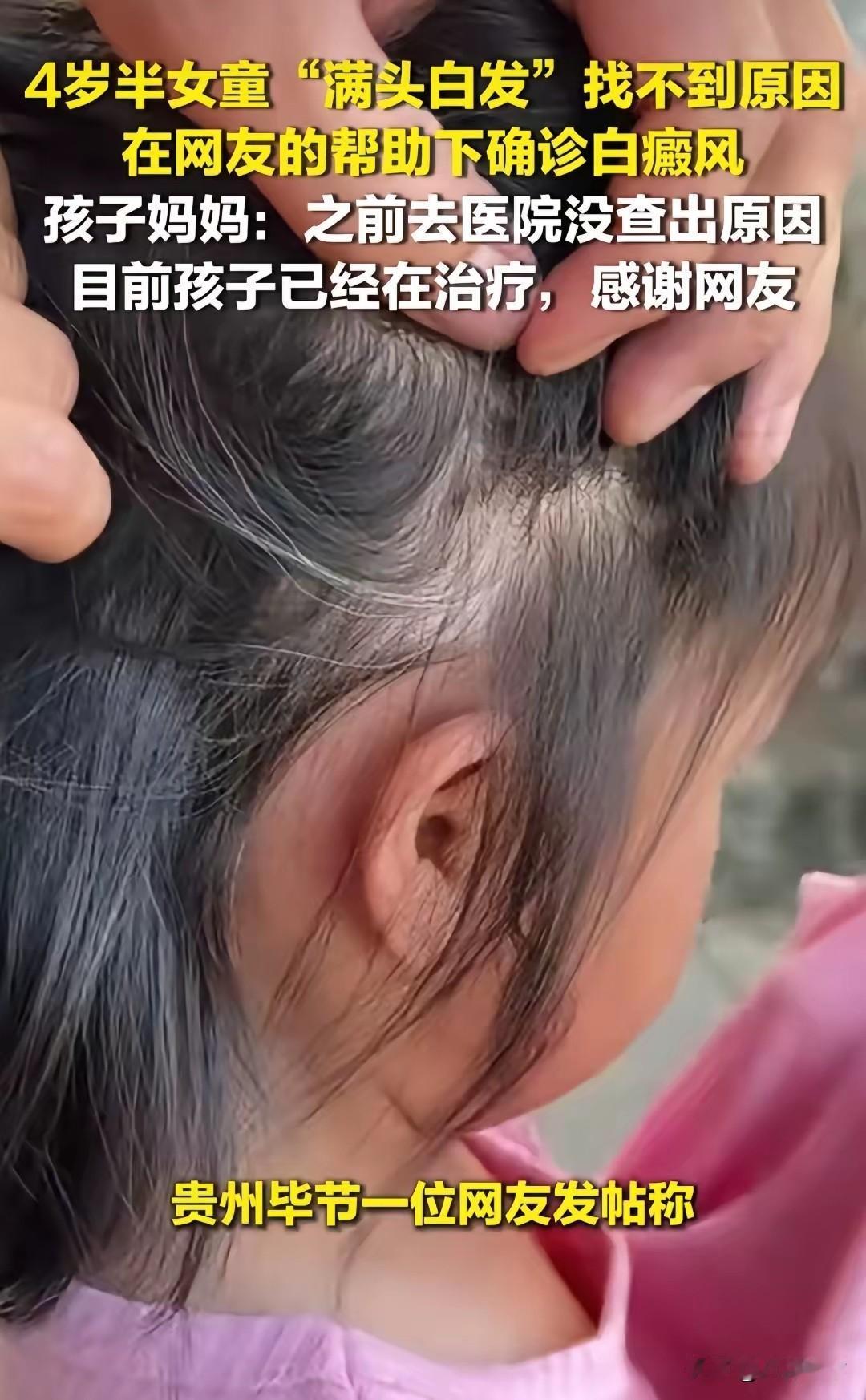 网友的含金量还在一直上升！
贵州一宝妈四岁半女儿满头白发却找不到原因，最后一热心