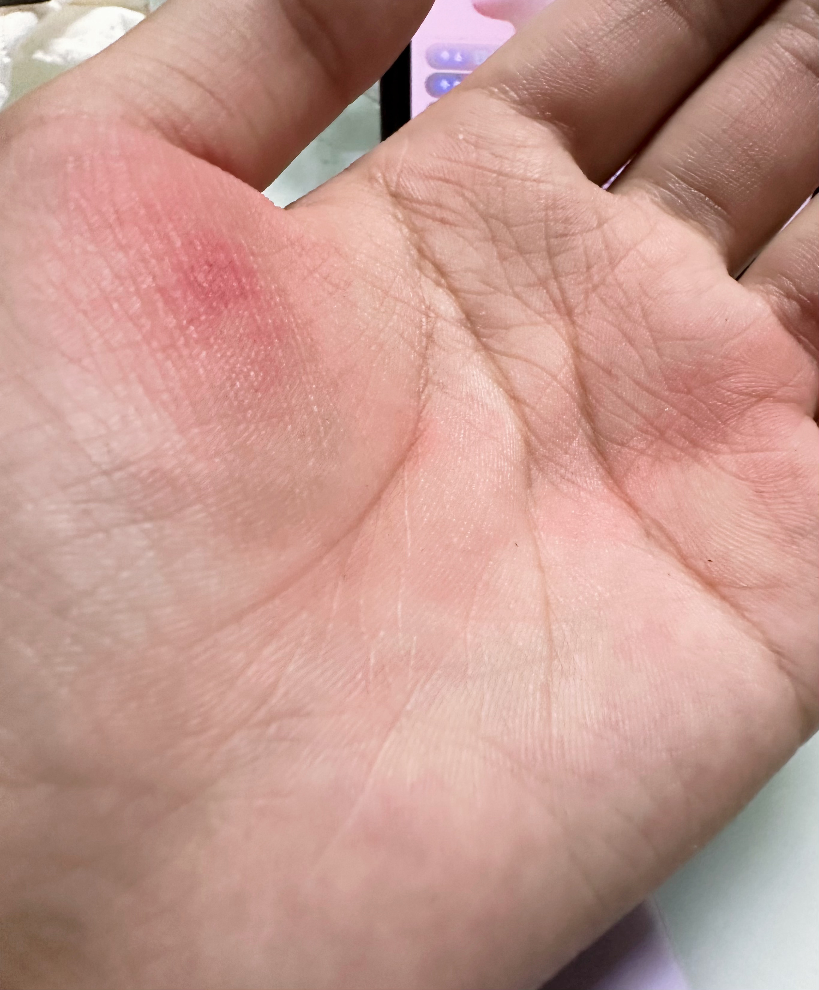 开个瓶盖负伤。“我们不是撕绿茶我是真的打不开瓶盖”