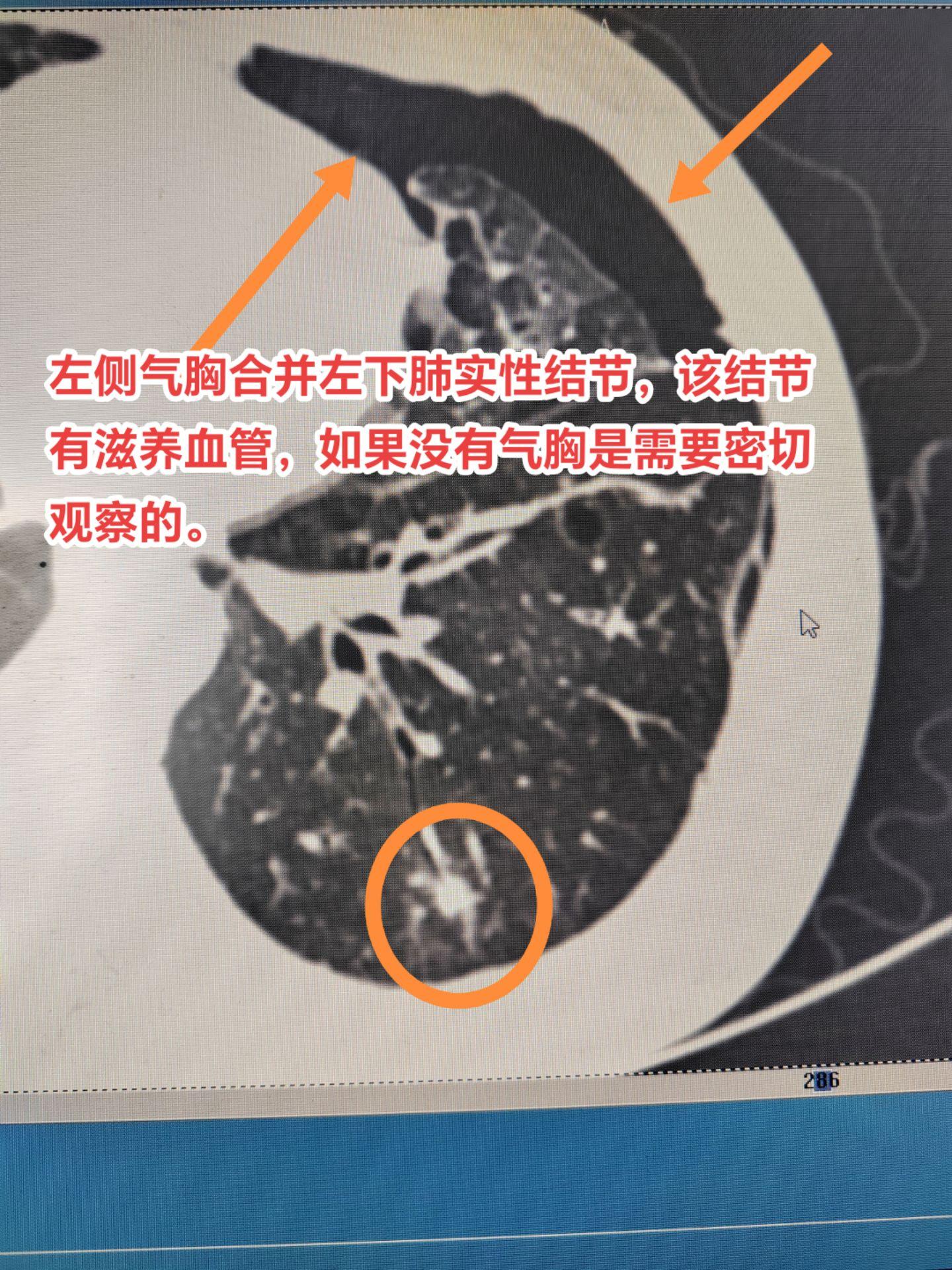 炎性结节会恶变吗？炎性结节恶变大部分是那些长期不消的慢性炎，但概率很低，从慢性炎为起始的恶变过程是非常缓慢的。一般是长期的炎性刺激导致细胞变异出现不典型增生的异常细胞，该细胞有可能继续变异成肿瘤细胞，最终恶变成癌。
但是一般的实性结节如果是恶性，一开始就是恶性，不存在所谓的癌变，此类肿瘤进展非常迅速，与炎性结节恶变是完全不同的表现。