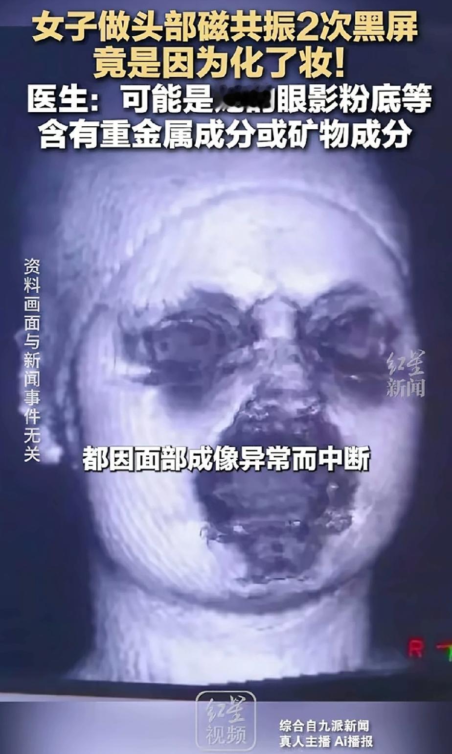 什么情况？小姐姐头痛，去做磁共振，结果，做了两次都黑屏。大夫还以为女子带假牙什么