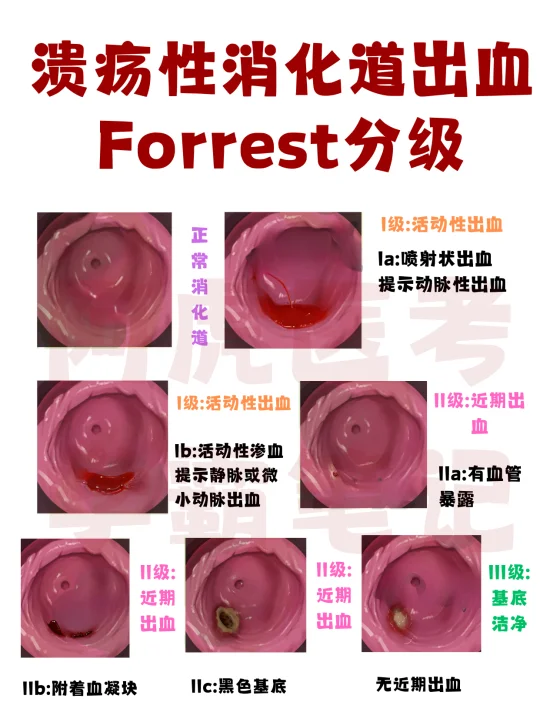 医学生笔记📒：溃疡性消化道出血👆