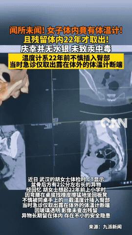 “彻底解释不清了！”湖北武汉，一女子参加体检时，意外发现盆骨里有奇怪异物，足足有
