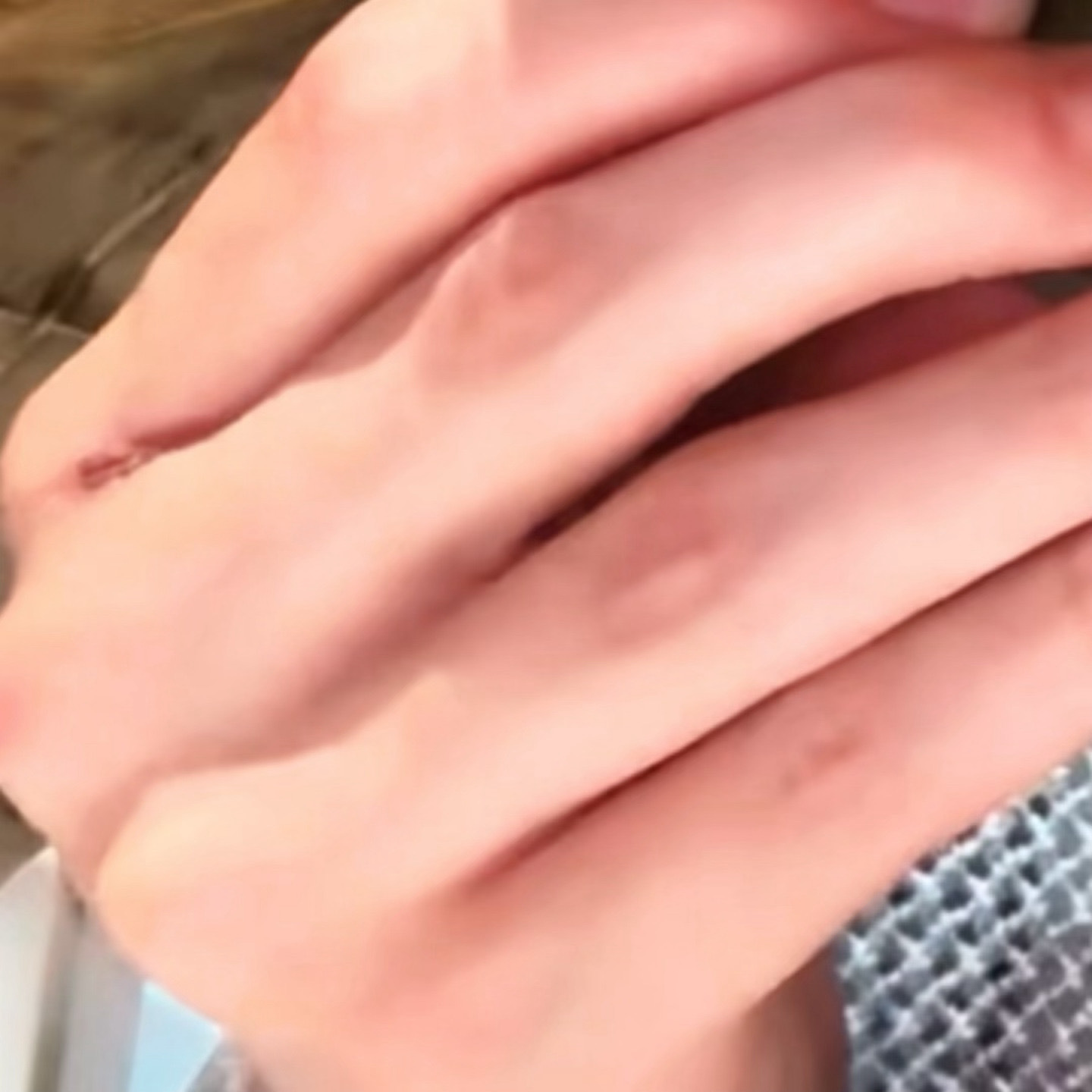 我真是艹了，这么深的一道口子。 