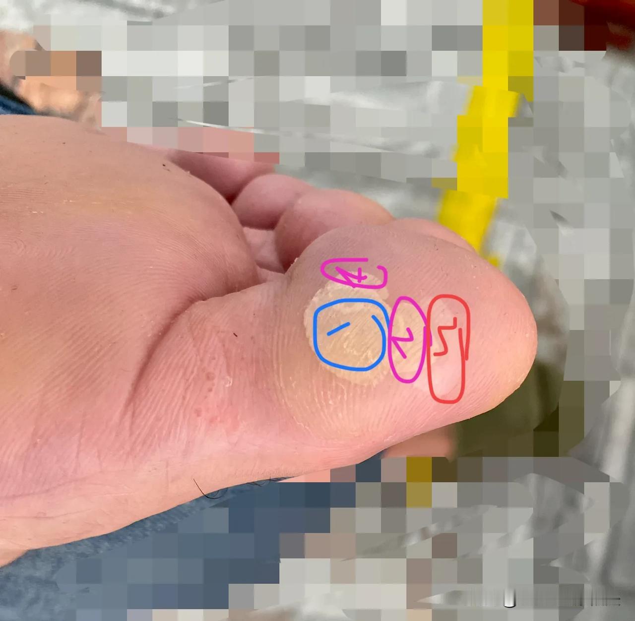 这样下去会不会被截肢啊！
打了三次篮球，磨了三次泡
1，2，3
这还真的是旧泡未