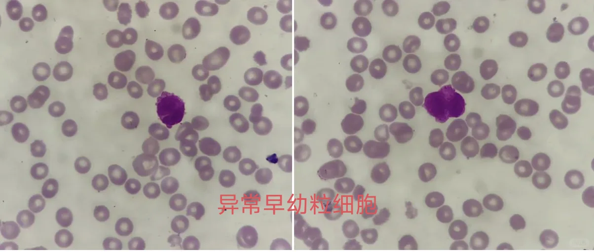 形态学也有危急值，存图查看
