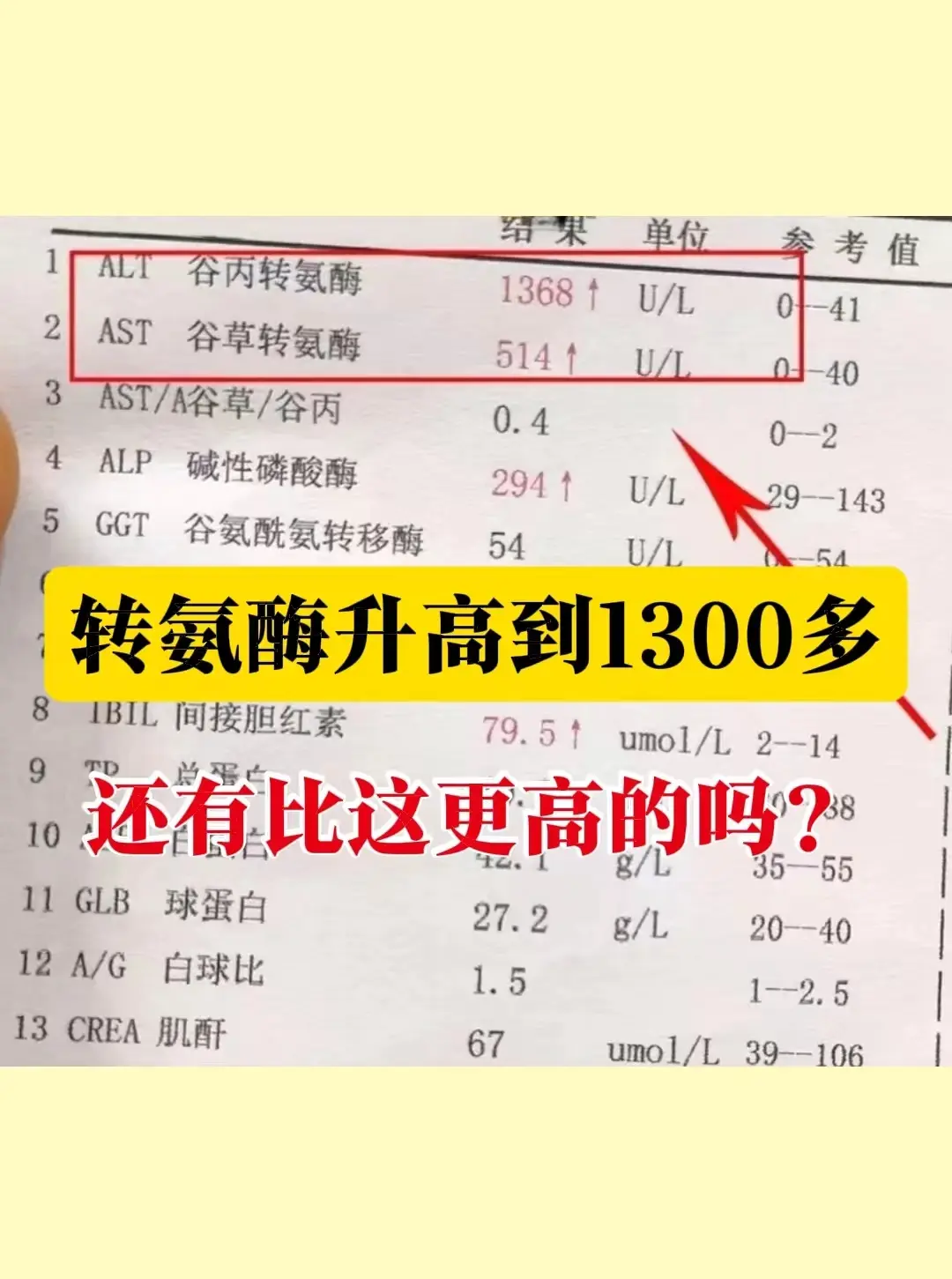 转氨酶升高到1300到底有多危险？这是前天专家门诊上一位济宁大三阳患者...