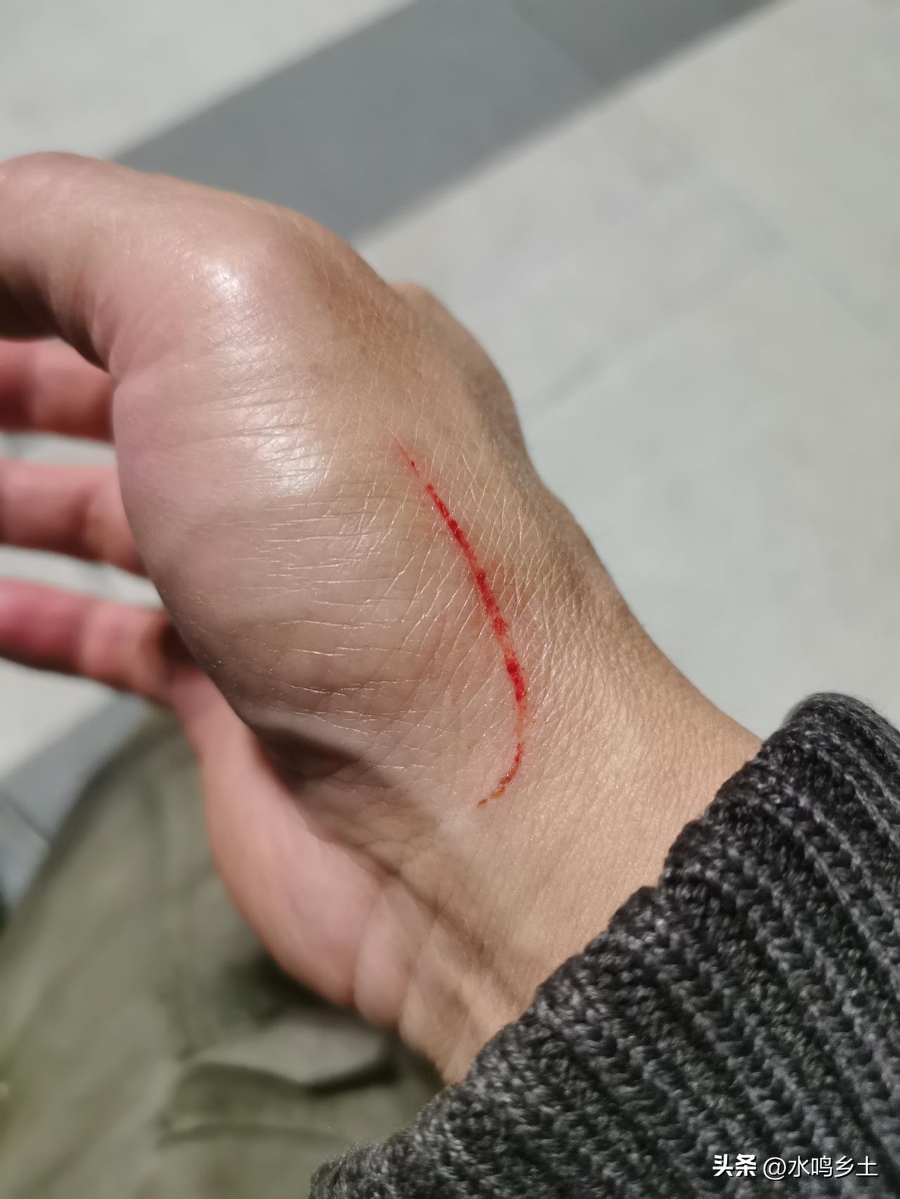 上山采药，皮外伤总是避免不了的，这个划伤形状有点像某个牌子的标志了！