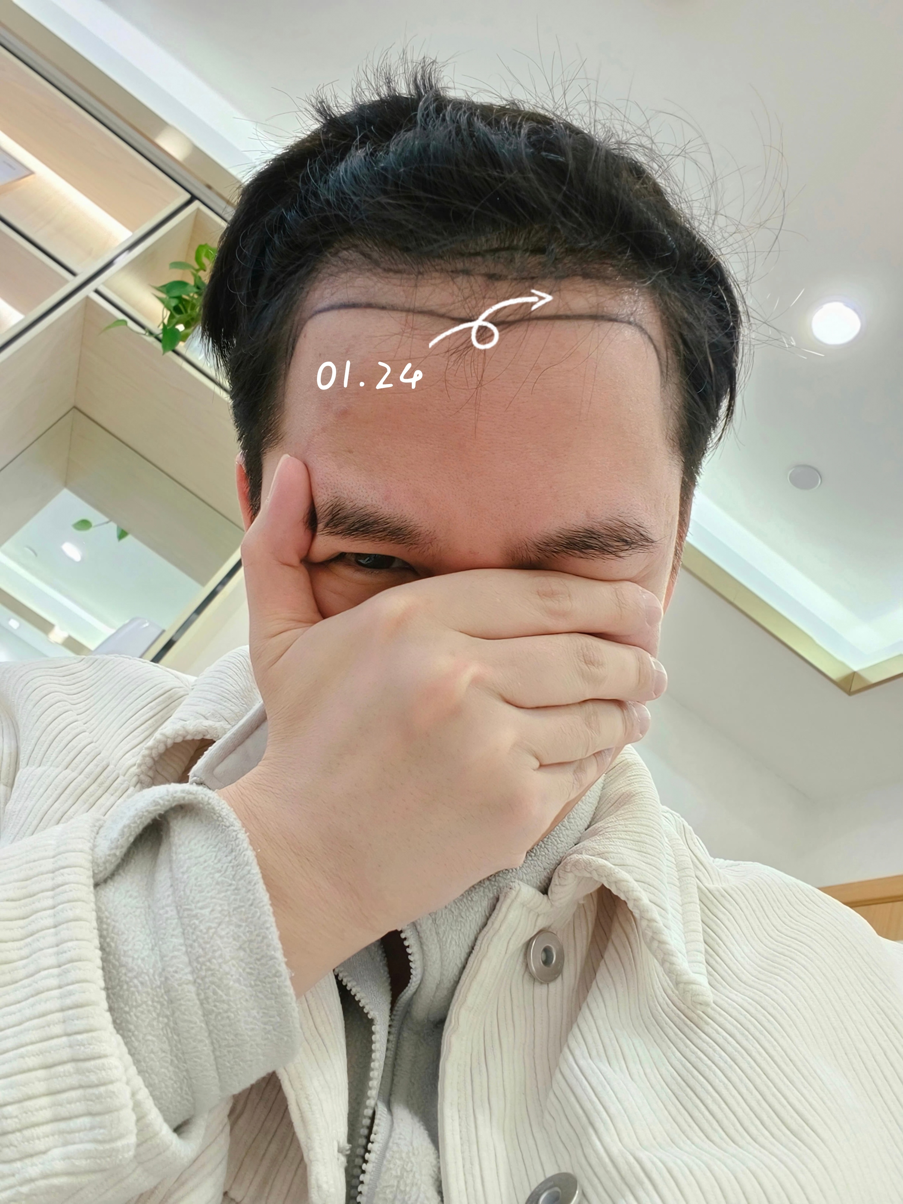 植发完4个月了！你们看看效果咋样？？其实我一直在观察它的变化！3月份我的毛囊炎爆