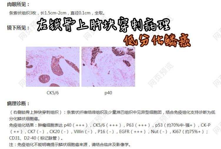 SMT样的食管低分化鳞Ca.男，69岁，因发现右颈部3.0cm肿块入院，肿块穿刺病理提示低分化鳞Ca，胃镜示食管20cm处1.2cm黏膜下隆起，表面光整，行诊断性剥离，创面基底疑似肿瘤组织，病理证实食管中低分化鳞Ca，PET-CT排除其他来源可能。少数特殊类型食管癌，可表现为黏膜下隆起，覆盖正常上皮，极少数甚至环周浸润而无明显隆起破溃，恶性程度高，易转移，预后差。