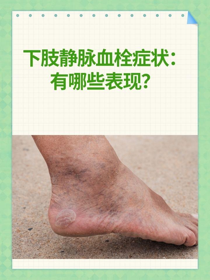 一个能预防血栓形成的“黄金动作” 血栓就像血管里的定时炸弹，小则影响血流，大则堵