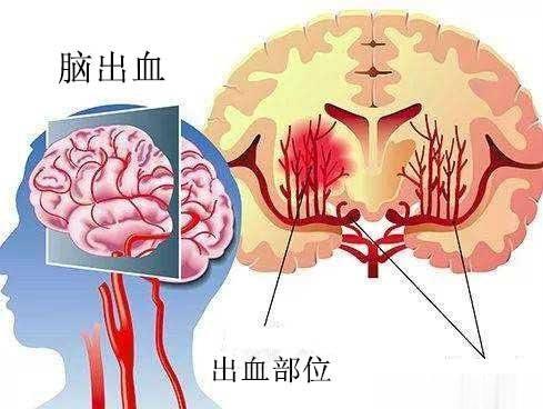 #微博健康公开课##健康美好生活计划##这个问题吃什么# 【晚餐不规律，脑出血风