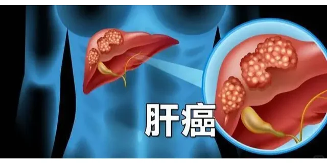 肝癌发展到中晚期，治疗的难度就会大大提升，对于患者的生命健康造成严重的...