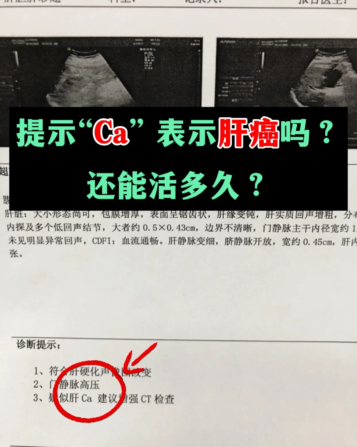 上周门诊上一位济南本地的患者老周来复查，拿着彩超报告慌了神：“教授，报...