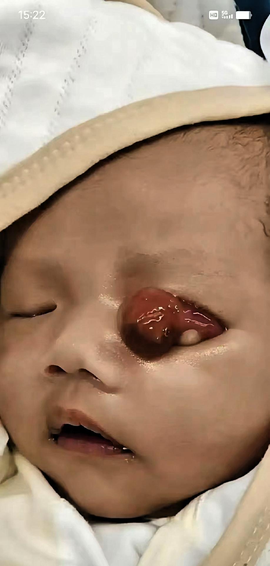 泪目！河南郑州，一家人在妇幼门口等着，娃刚落地，左眼皮上贴着一团肉
把眼睛压住了