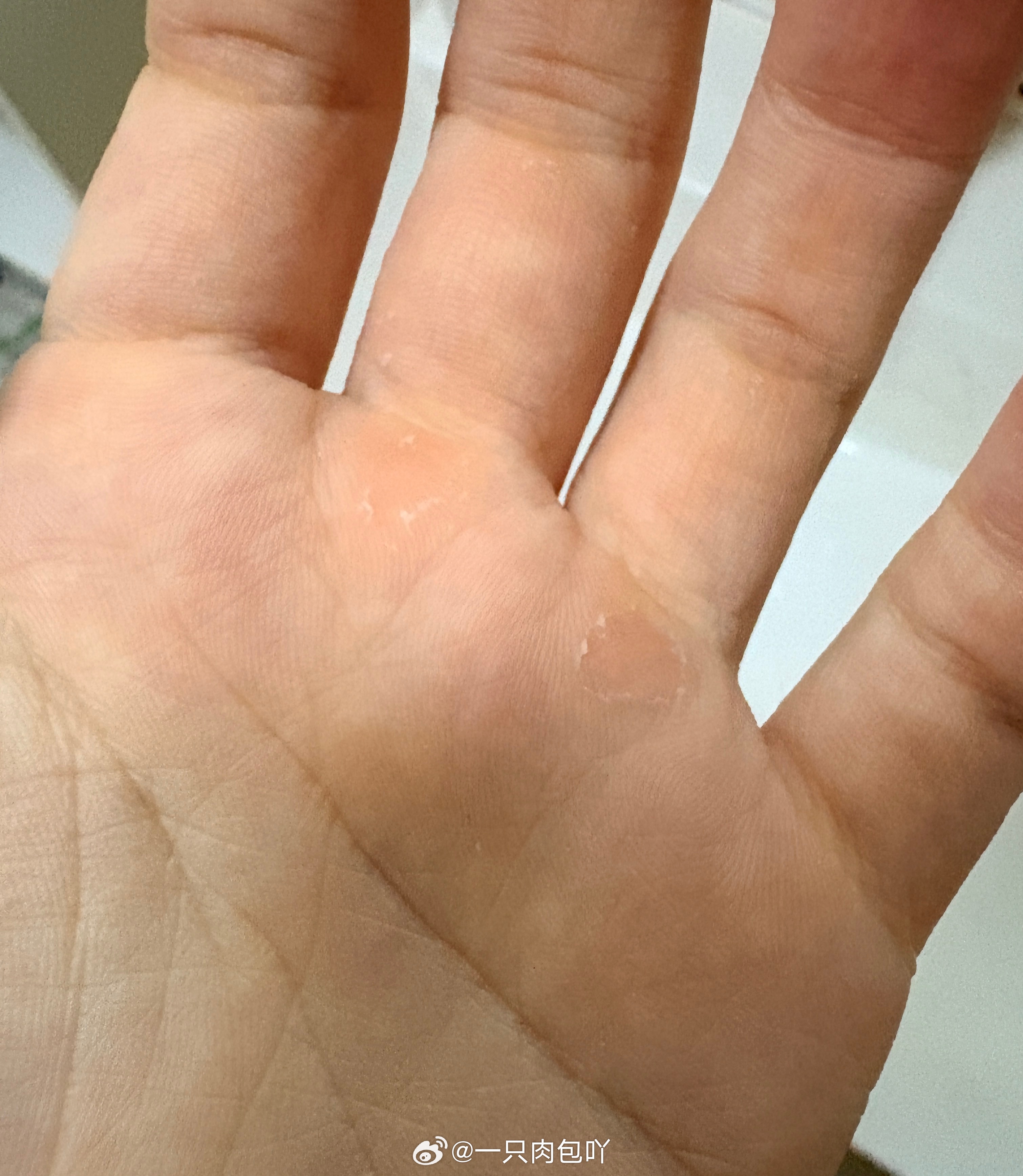 谁跟我一样没事扣自己手上的茧子玩