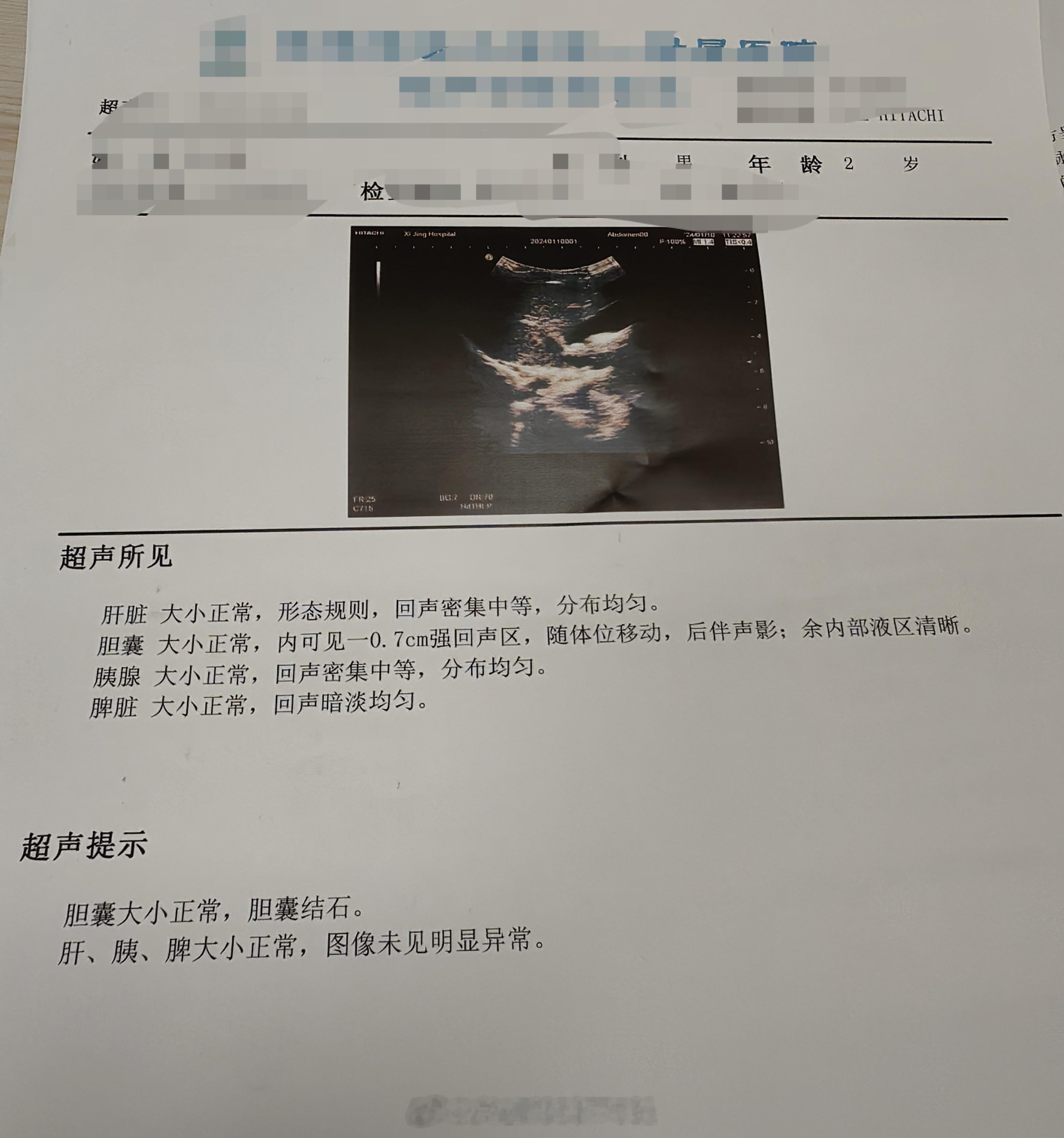 2岁的娃就有胆结石正惊叹之际，孩子妈妈说满月时就有胆结石了[晕]知道为什么吗？ 