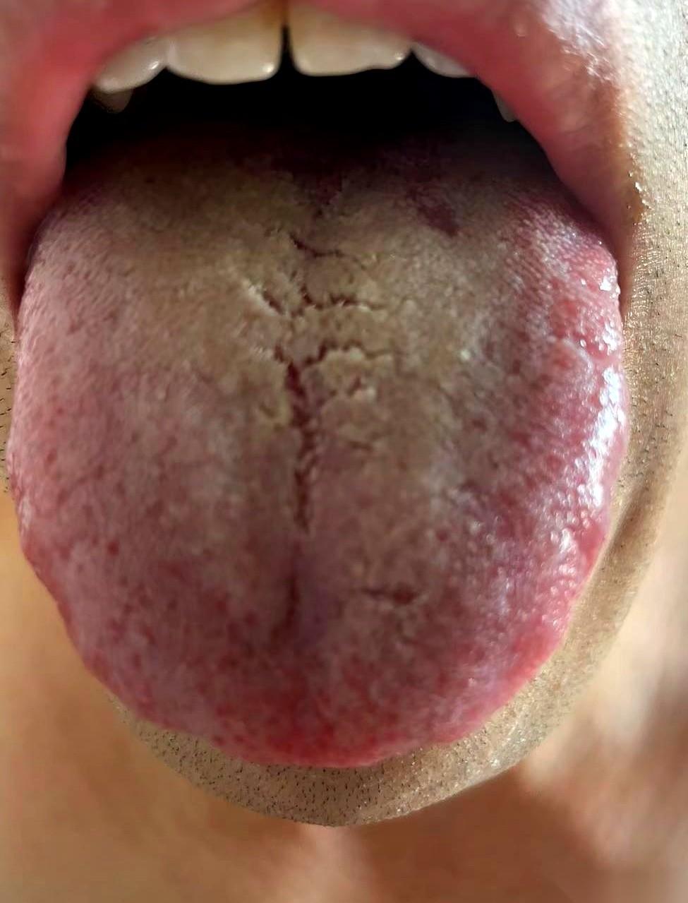 伸出舌头看看。
要是又黄又厚腻，跟铺了层老油似的，甚至还有裂纹，先别急着反思自己