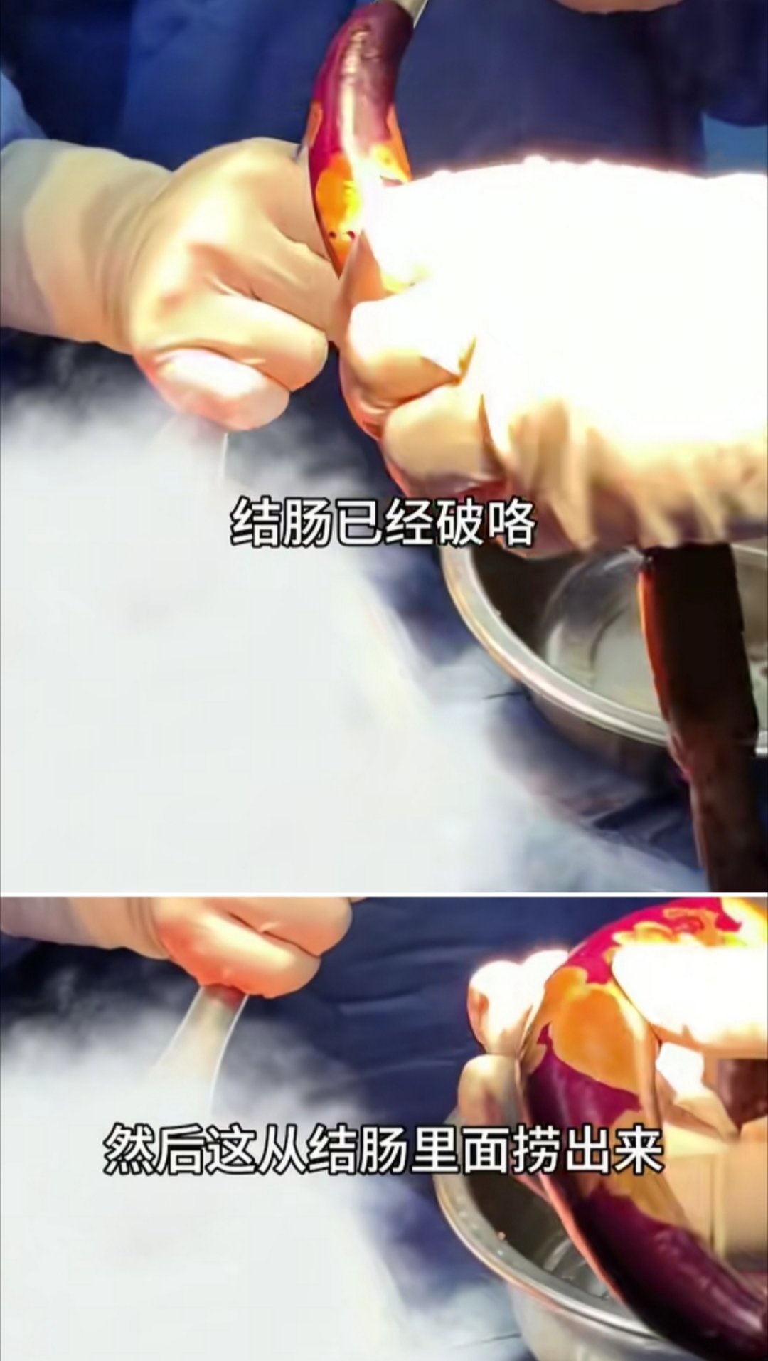 法国24岁男子将炮弹塞进肛门炸裂！¹ 每每看到这种新闻就想说：真是太不小心了！²