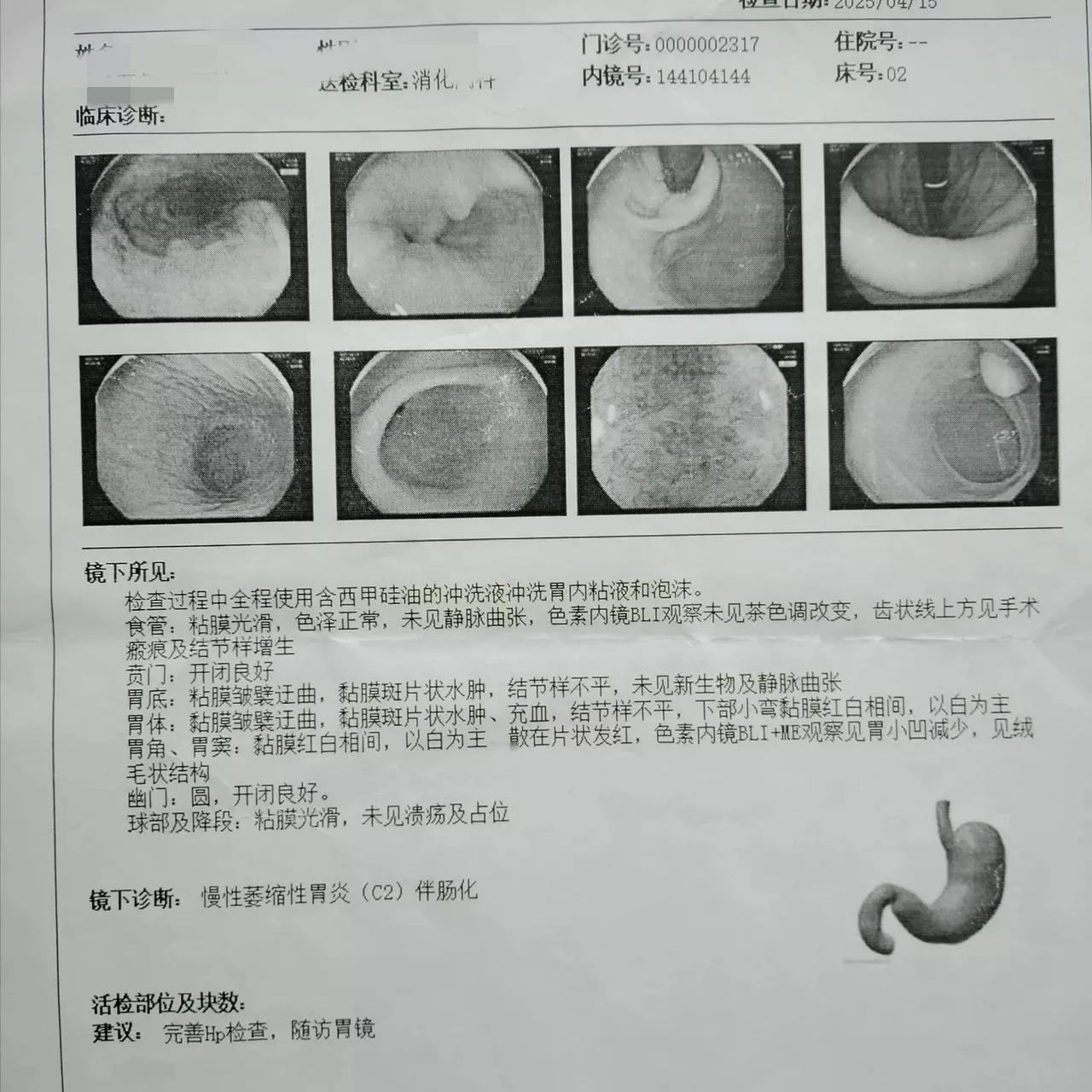 萎缩性胃炎复诊手记
昨天来复诊的患者有17位，其中11位萎缩性胃炎患者，发现三个