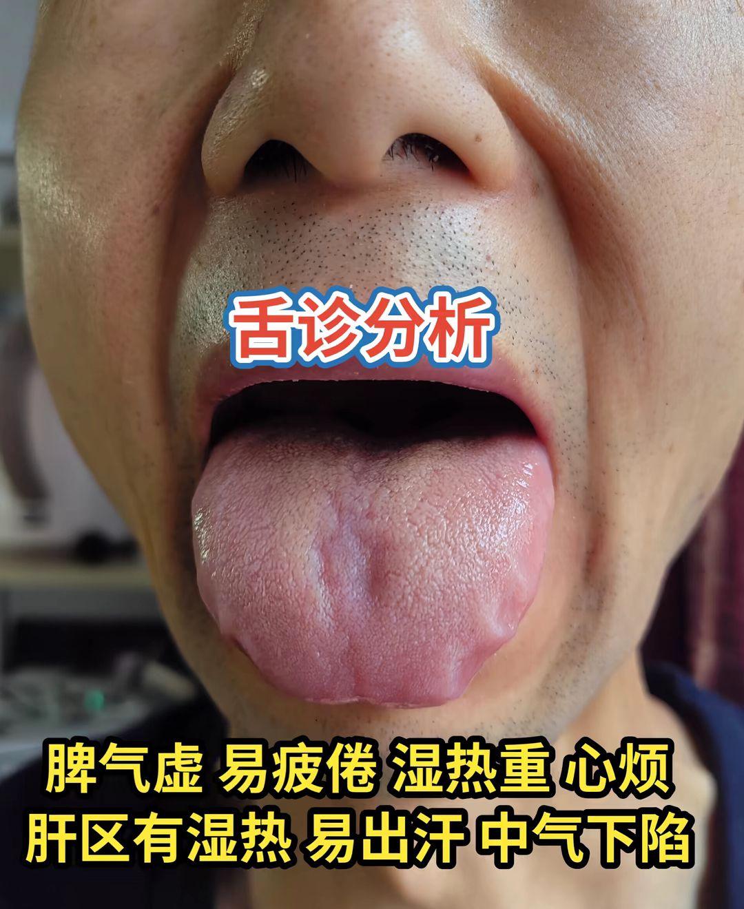 四种脾虚舌象 看看你是哪种