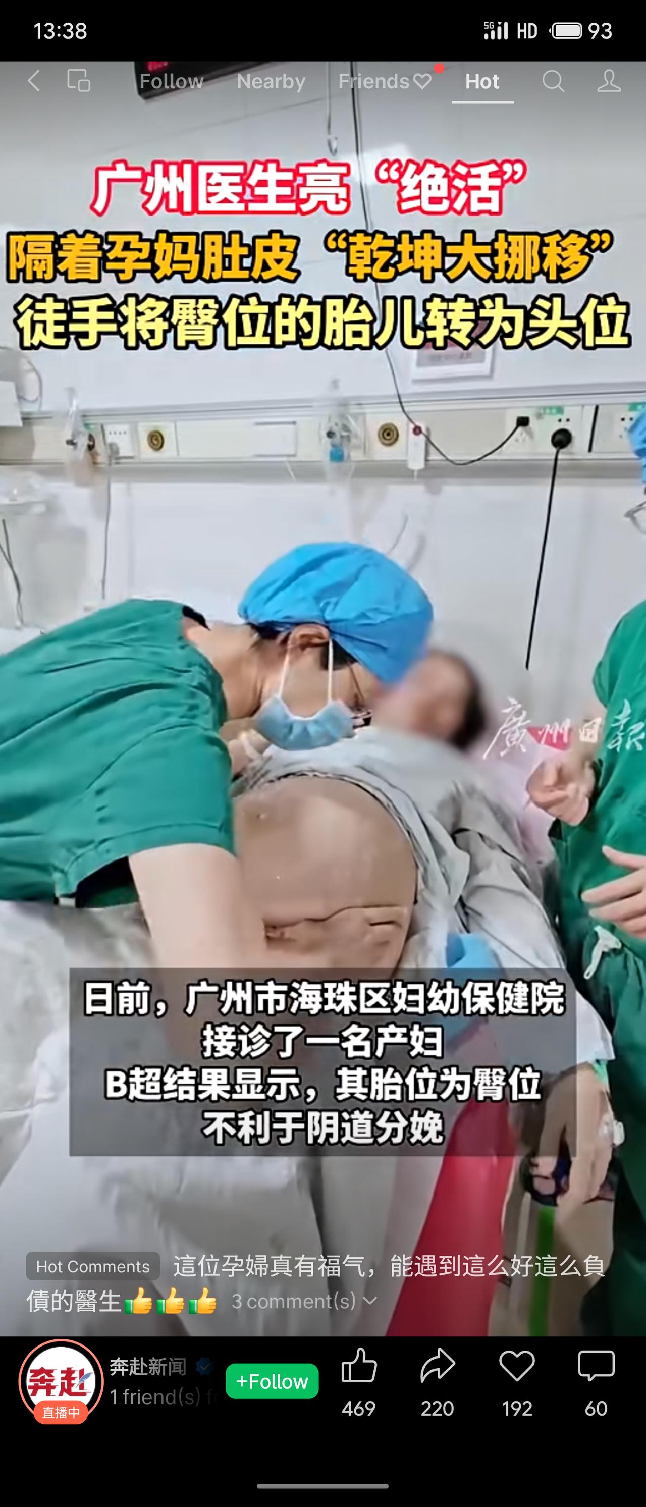 广州海珠区妇幼保健院潘东娜主任为一名臀位产妇成功实施徒手臀位外侧转术，将胎儿转为