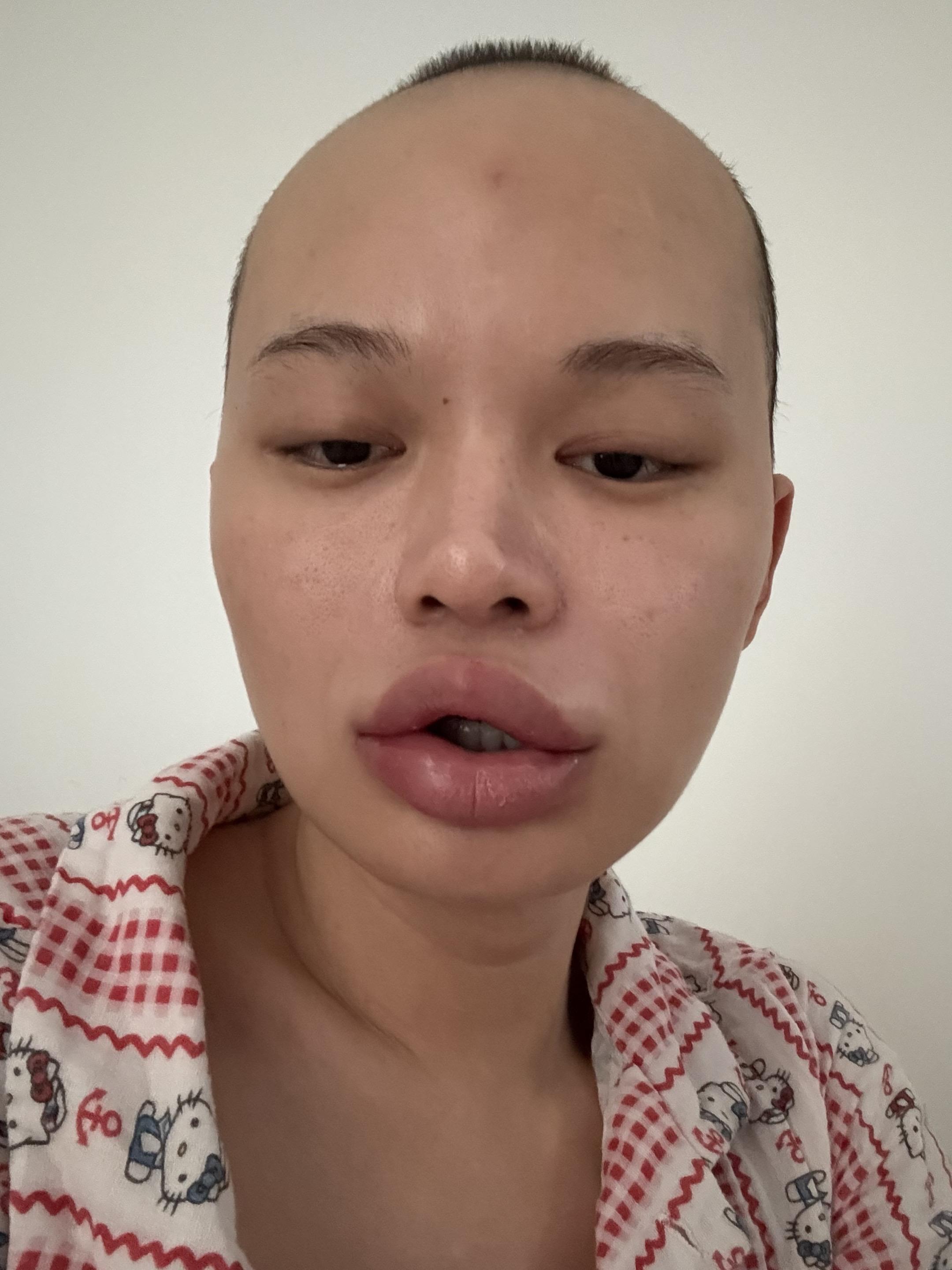 发烧一觉醒来，嘴里的玻尿酸全发炎了…