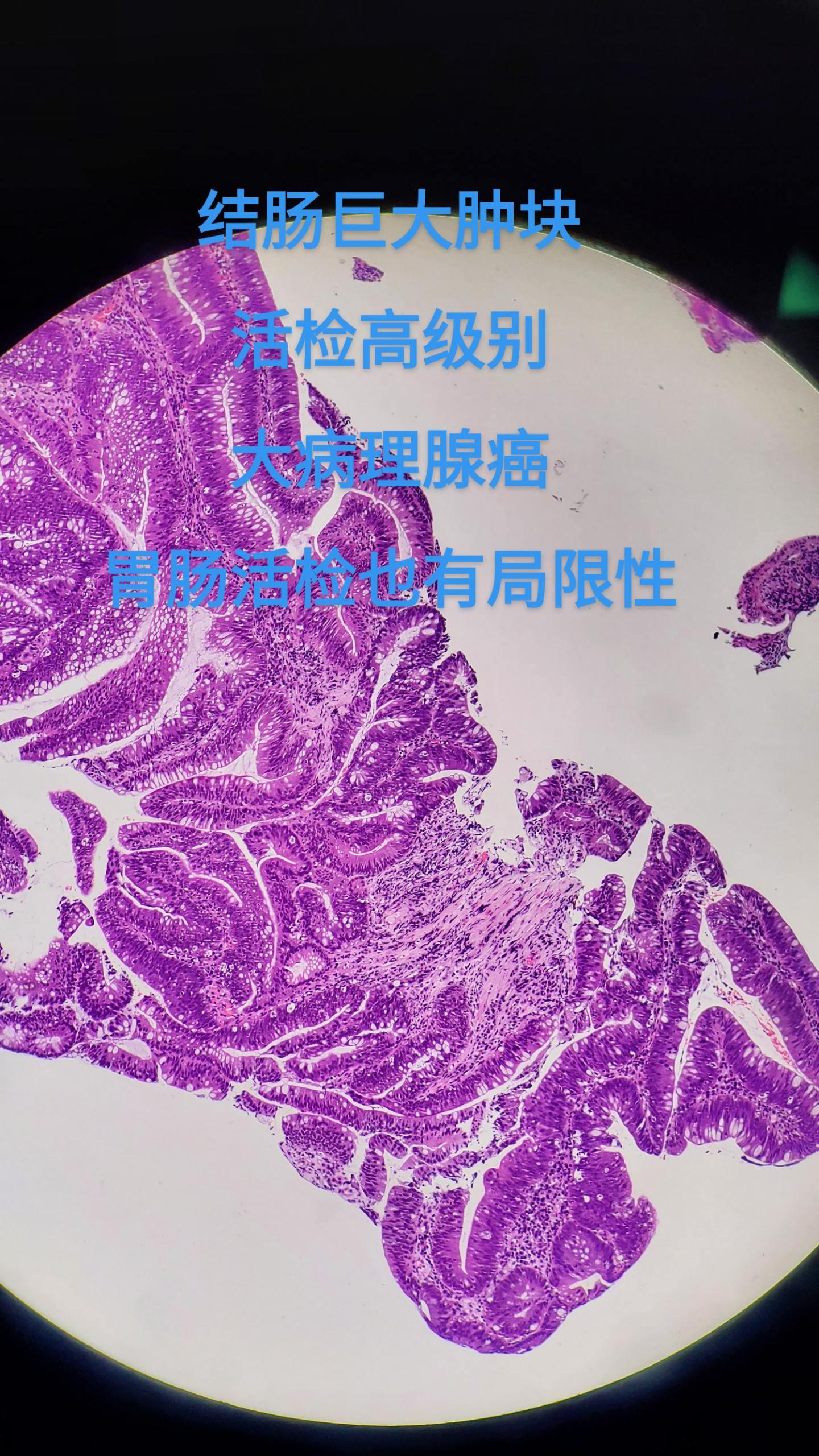 结肠腺癌
