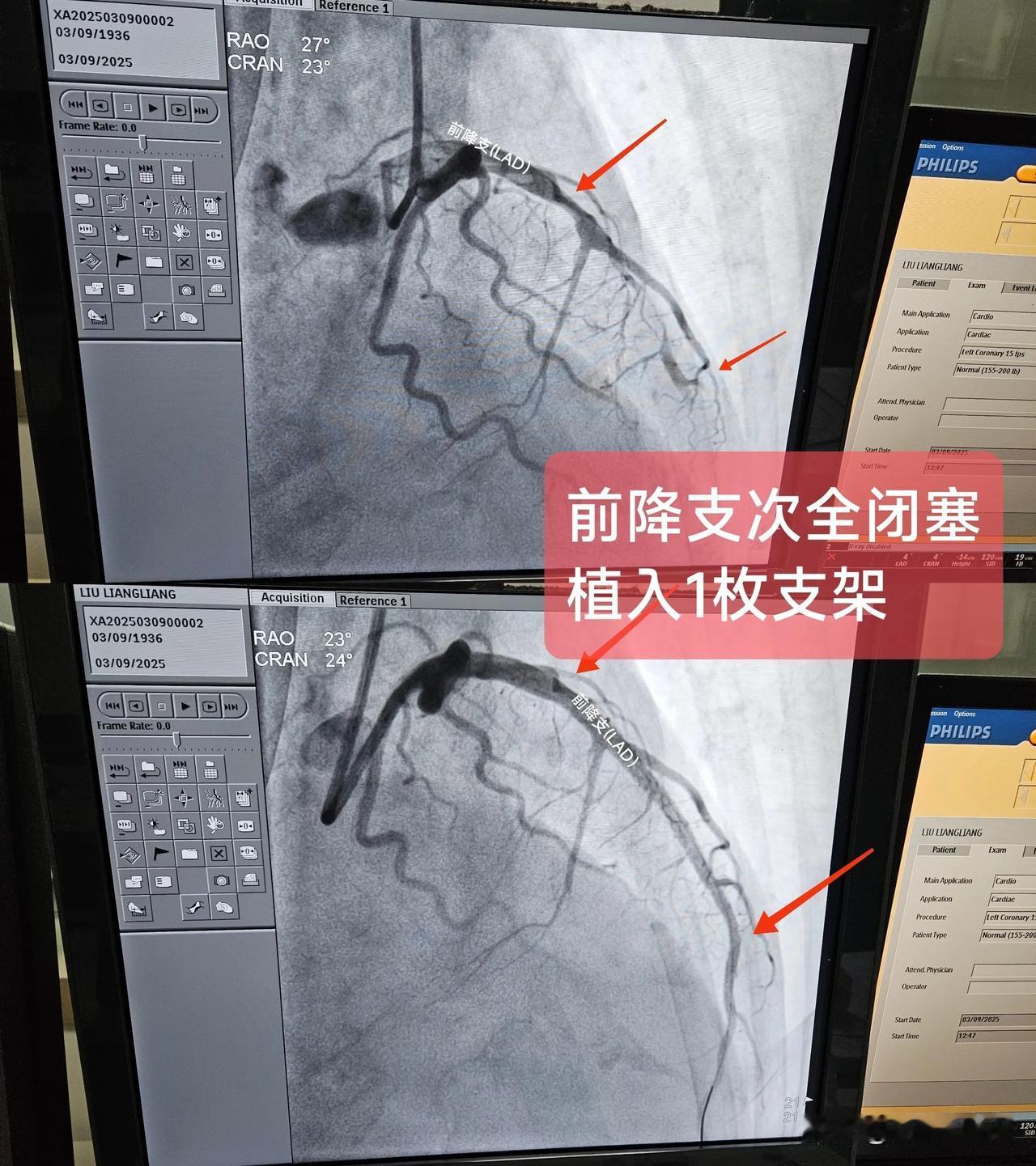 急性ST段抬高型心肌梗死
（前降支次全闭塞)
一.概念：
左前降支走行于室间沟内