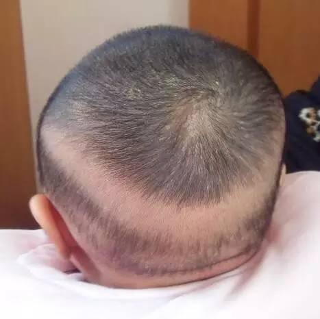 枕秃是缺钙导致的吗？#儿童健康守护计划#  枕秃大多是宝宝因为出汗、发痒或者玩耍