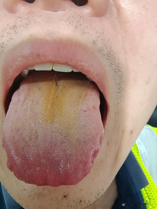 舌根都快烧焦了，还不知道调理，你在等啥呢大哥[what][what][what]