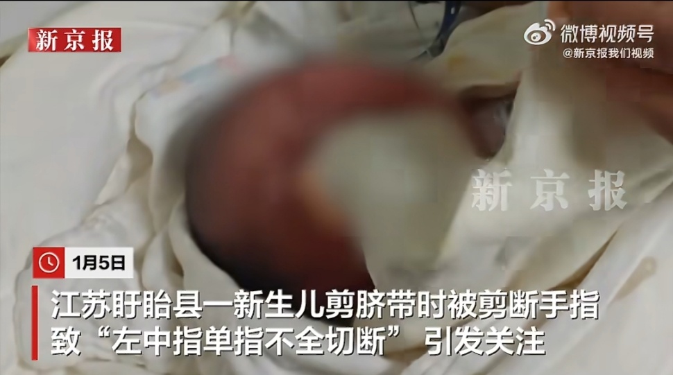 助产士疑剪断男婴手指医院涉多起医疗纠纷新生儿手指被误剪，绝非一句“意外”就能搪塞