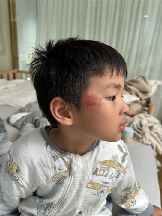 摔伤了，在线求怎么护理