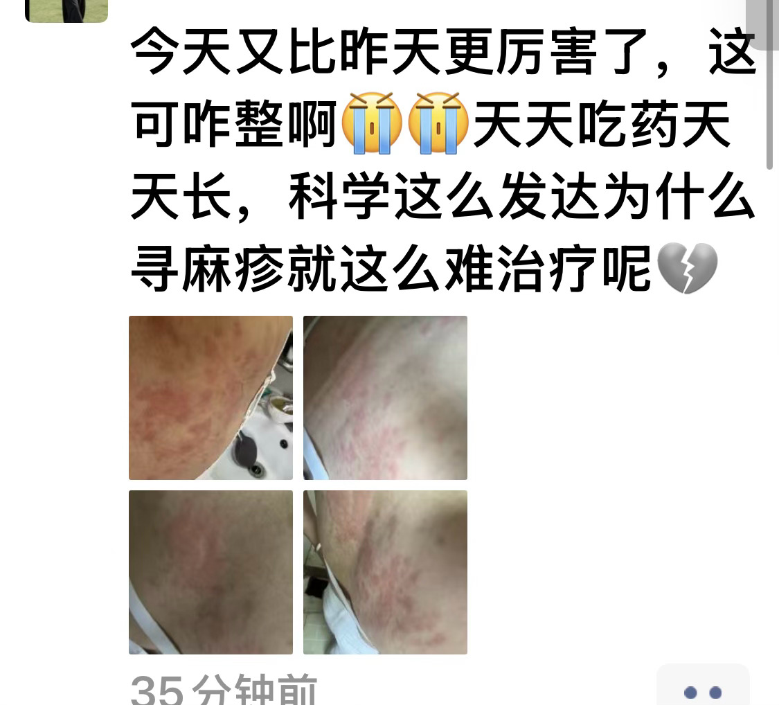 帮朋友圈朋友问的，看到她朋友圈救助，有人知道这种荨麻疹，用什么药好？看她朋友圈已