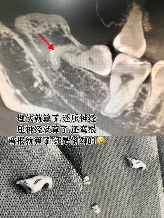 埋伏智齿：反正没人看的见，我就随便长好了