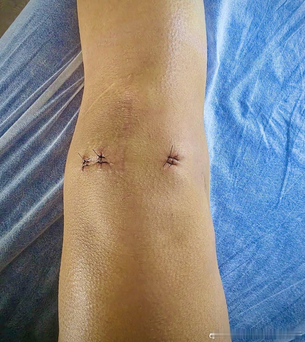 巴黎奥运会半决赛因伤退赛的西班牙名将马林选择做了第三次右膝手术很长一段时间里，我