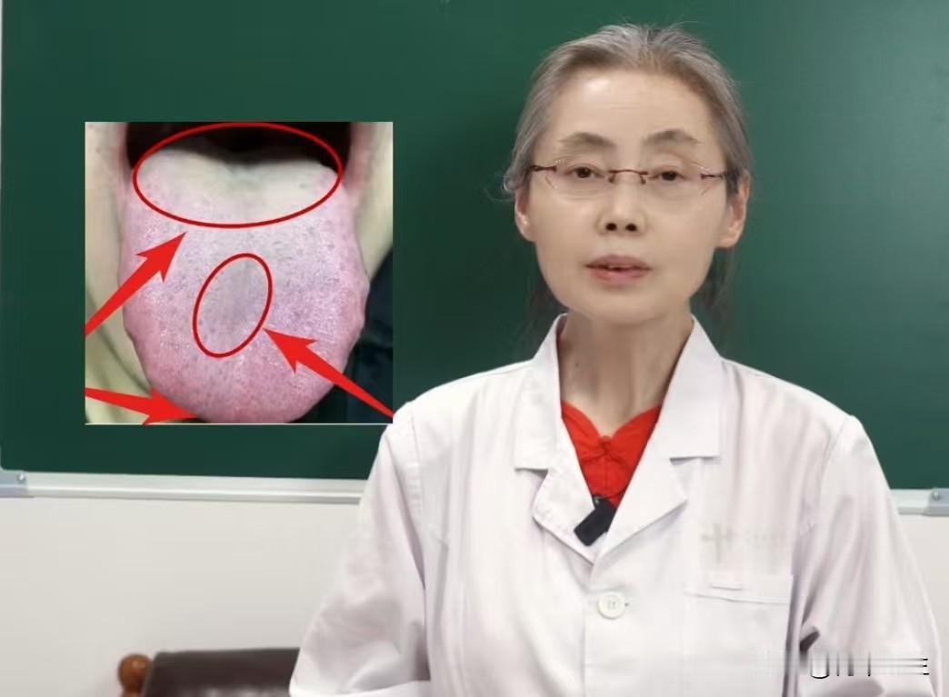 这种舌头真是令人头疼，湿热，阴虚夹杂着气虚

门诊上遇到那么多功能差的患者，这个