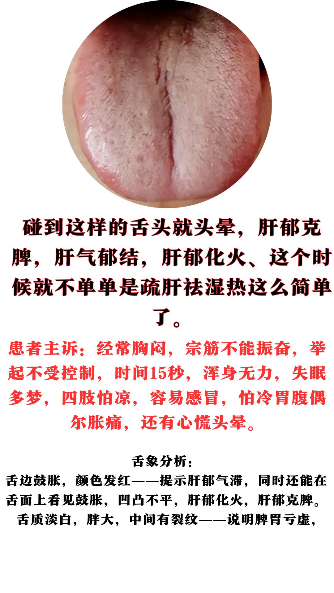 碰到这样的舌头就头晕，肝郁克脾，肝气郁结，肝郁化火、脾肾阳虚，这个时候就不单单是