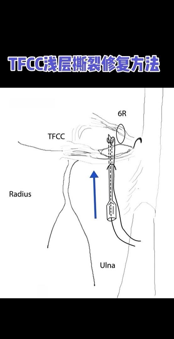 TFCC浅层撕裂修复方法。经6R入路修复三角纤维软骨复合体（TFCC）...
