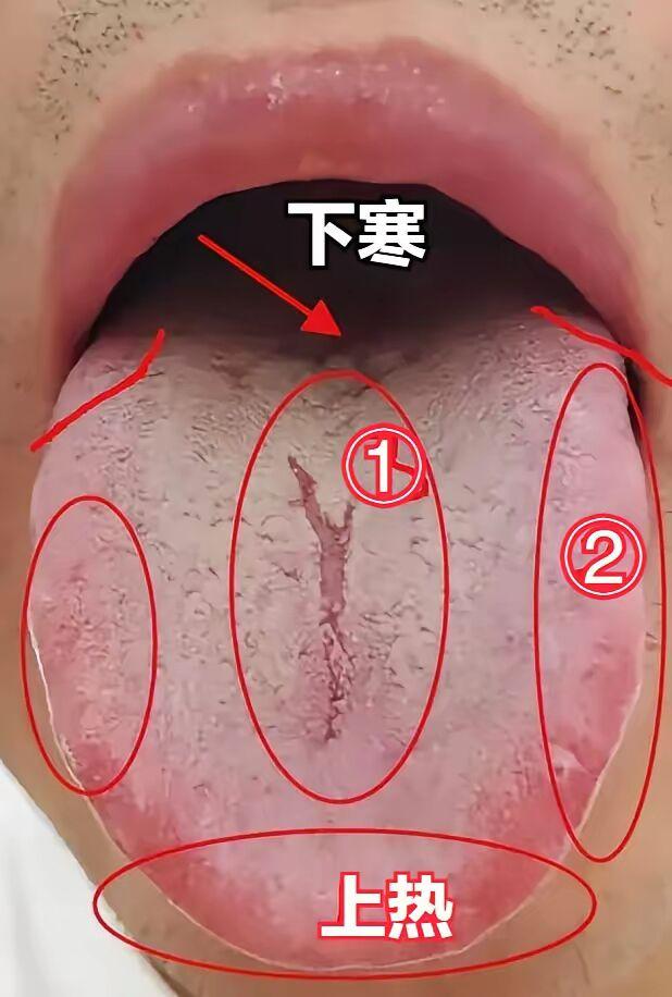 上热下寒症状频发，交泰丸为何失灵？
对于典型的上热下寒症状，尽管服用了交泰丸却未