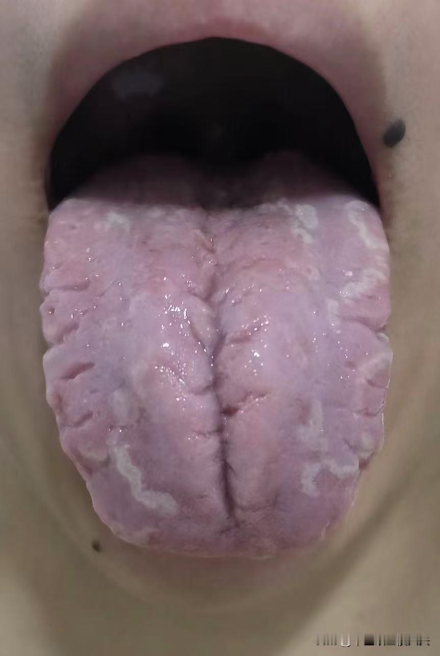 22岁小姑娘，肾精亏的真不像话，就这还不知道节制！[撇嘴]

前几天门诊来了一位