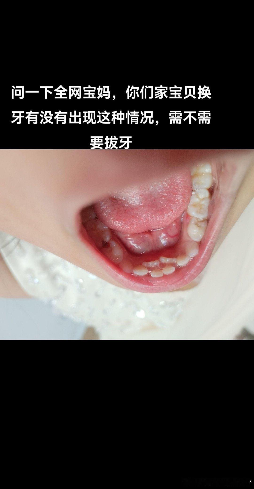 第一颗乳牙 ，新的牙齿都长出来了，乳牙还不见掉，考虑要不要拔？？[允悲][允悲]