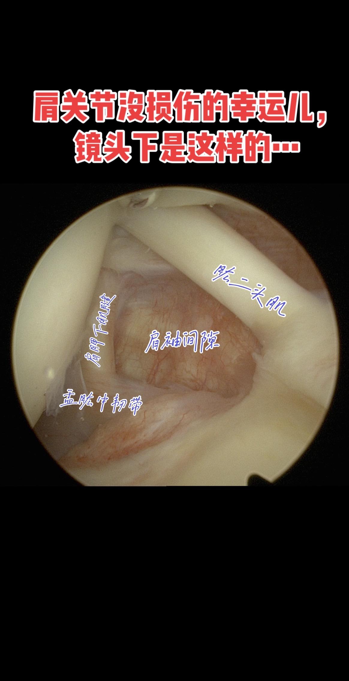 关节镜下的“完美肩关节”长啥样。肩关节肩袖