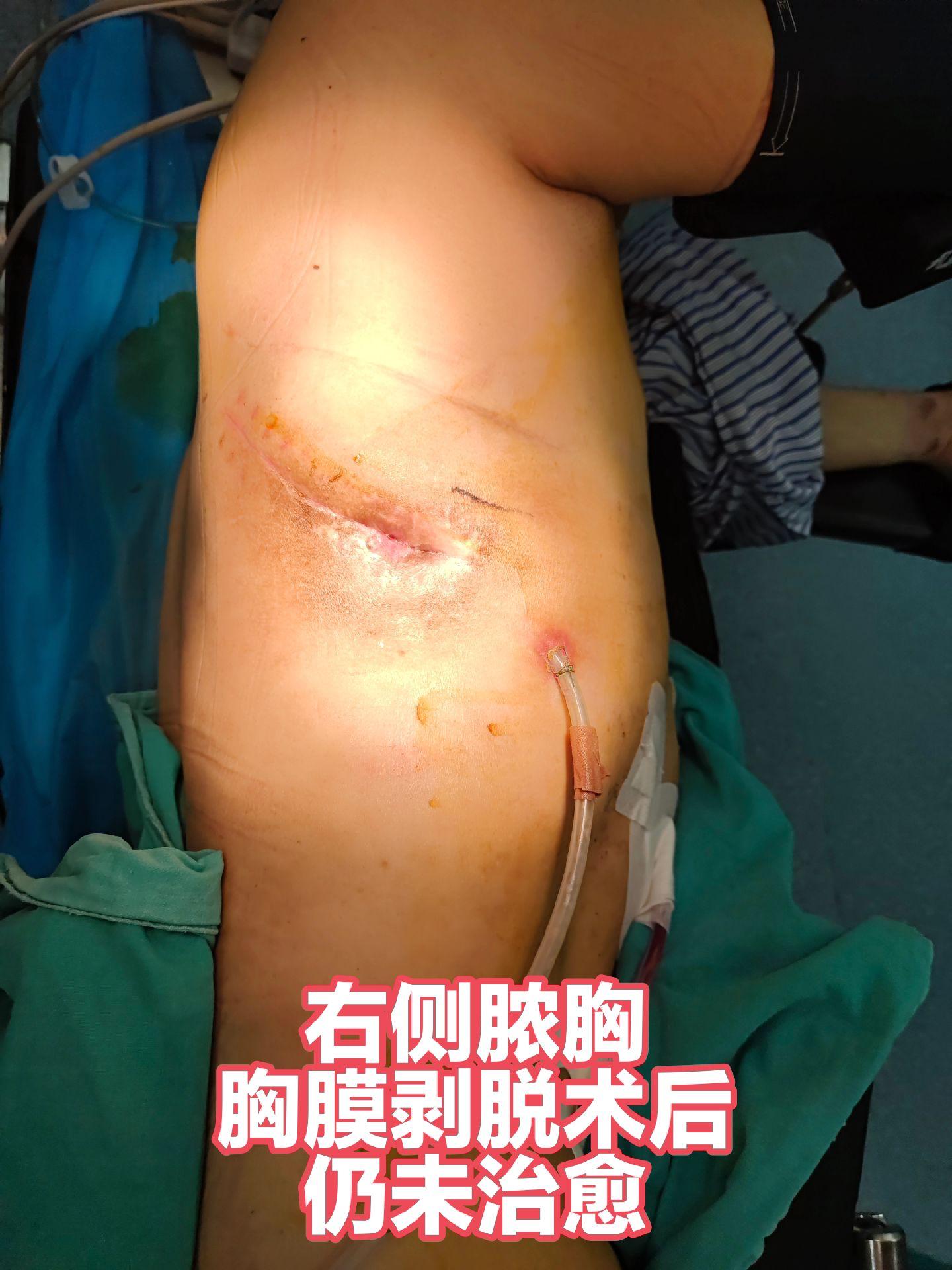 顽固性脓胸（支气管胸膜瘘）在上海七院已为常规术式，带管三年患者，术后三...